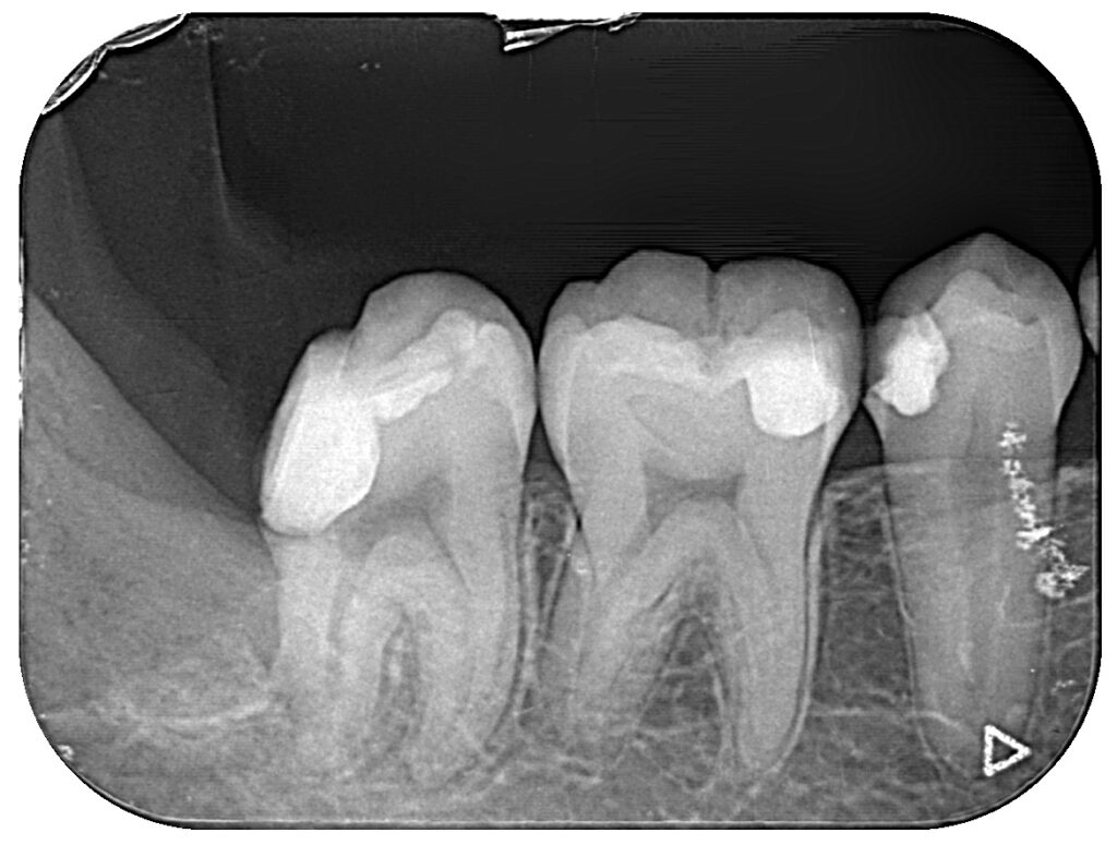 親知らずを抜歯したあとのレントゲン写真