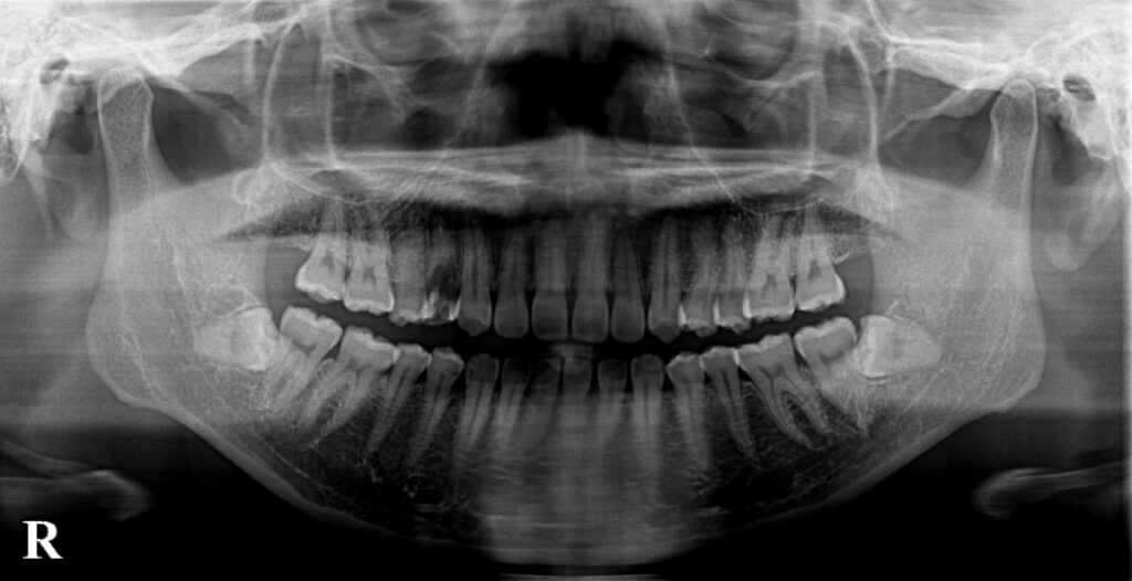 横向きに埋まった親知らずのレントゲン
